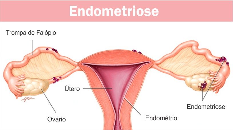 Endometriose: causas, sintomas, diagnóstico, tratamento e recuperação