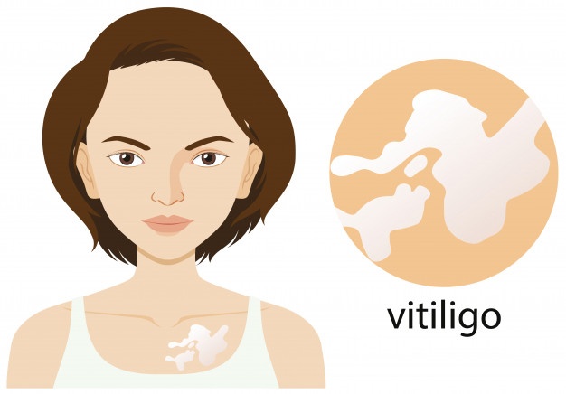 Vitiligo tem cura? Saiba o que é, suas causas, sintomas e tratamento