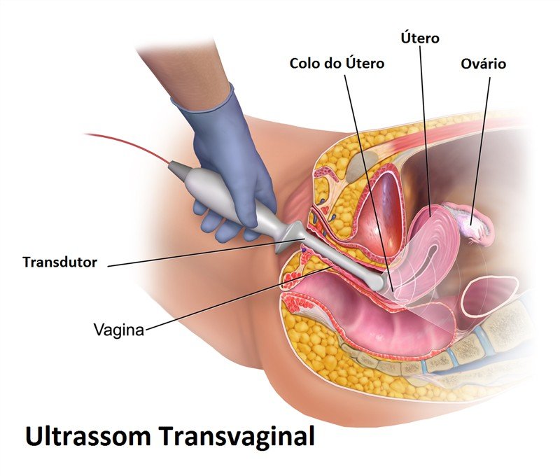 Ultrassom Transvaginal: para que serve, como é feito, preço médio