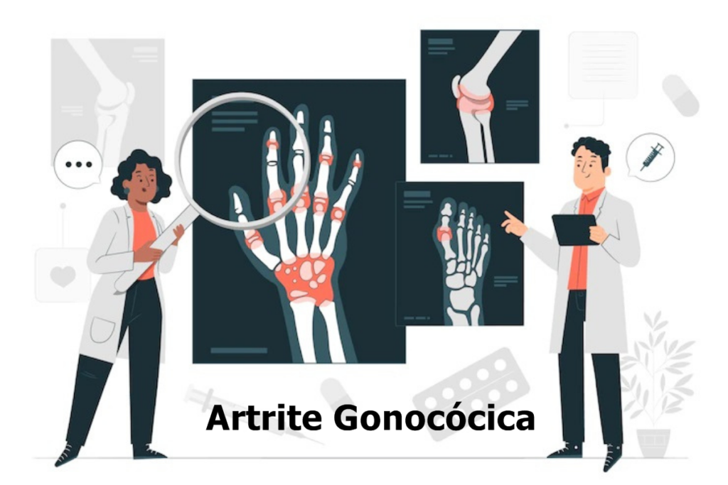 Artrite gonocócica: uma infecção por gonorreia que afeta as articulações
